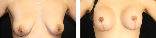 Before and after tubular breasts