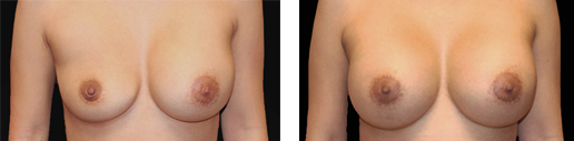 Before after asymmetric breasts