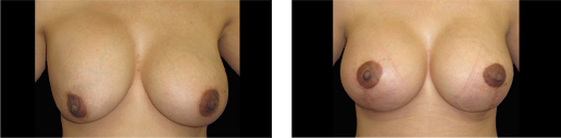 Before after breast implant revision
