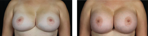 Before and after desire for larger breasts