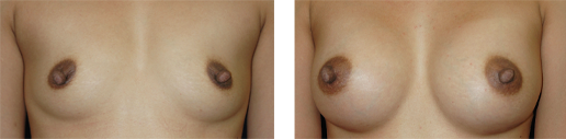 Before and after small breasts