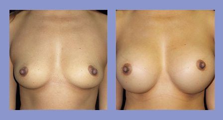 Breast augmentation before and after real patient