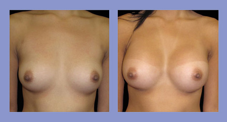 Breast augmentation before and after real patient