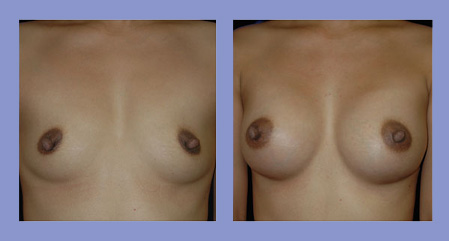Breast augmentation before and after real patient