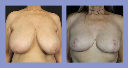 Breast lift before and after real patient