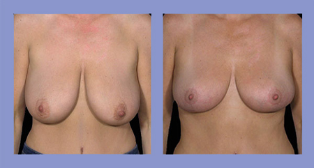 Breast lift before and after real patient