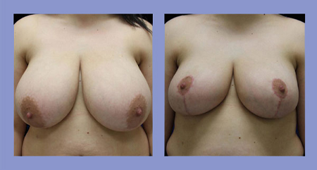 Breast lift before and after real patient