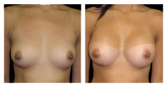 Before and after breast augmentation surgery