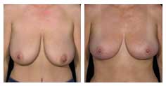 Before and after breast lift