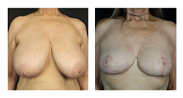 Before and after breast surgery