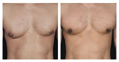 Before and after male breast reduction