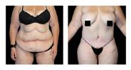 Before and after tummy tuck