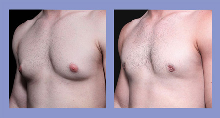 Male breast reduction before and after real patient
