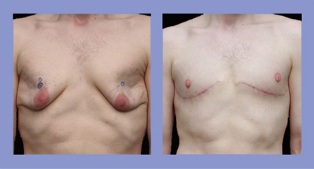Male breast reduction before and after real patient