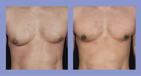 Male breast reduction before and after real patient