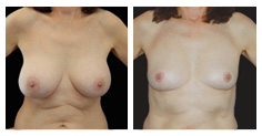 Before and after breast implant removal