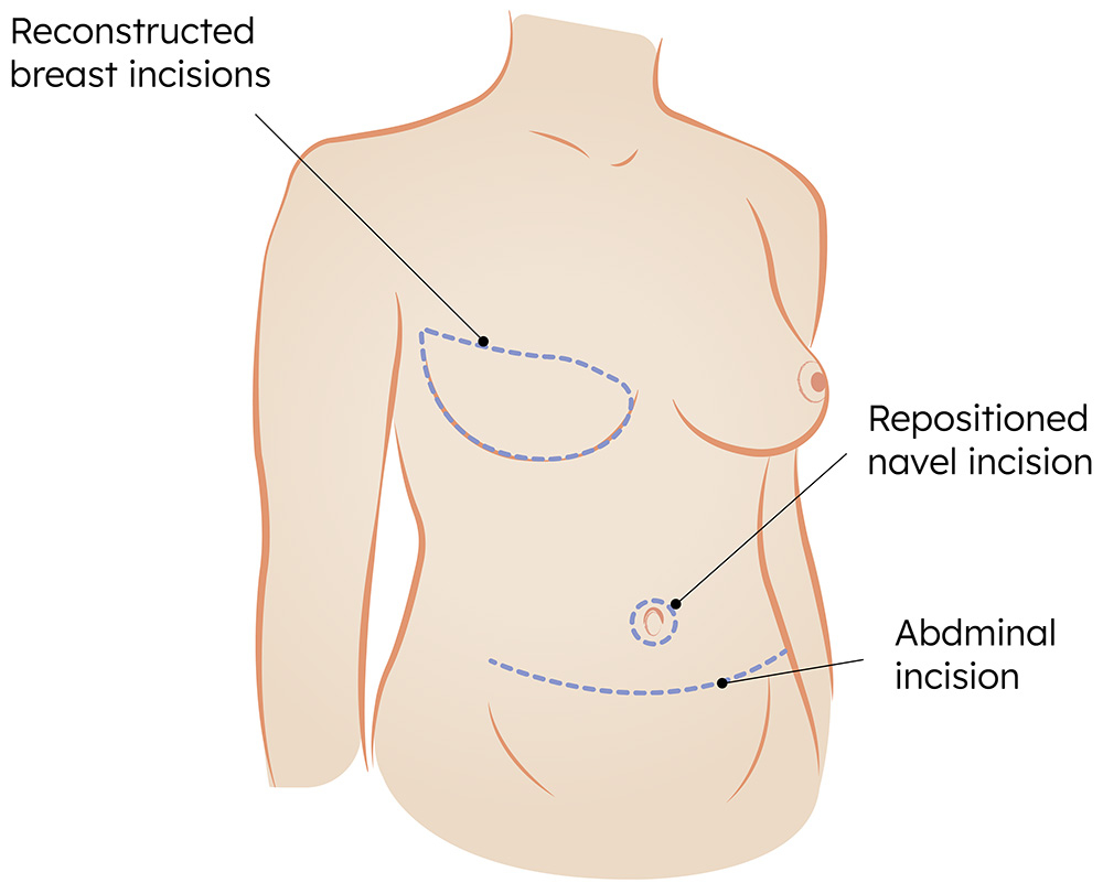 Breast reconstruction with abdominal tissue flap