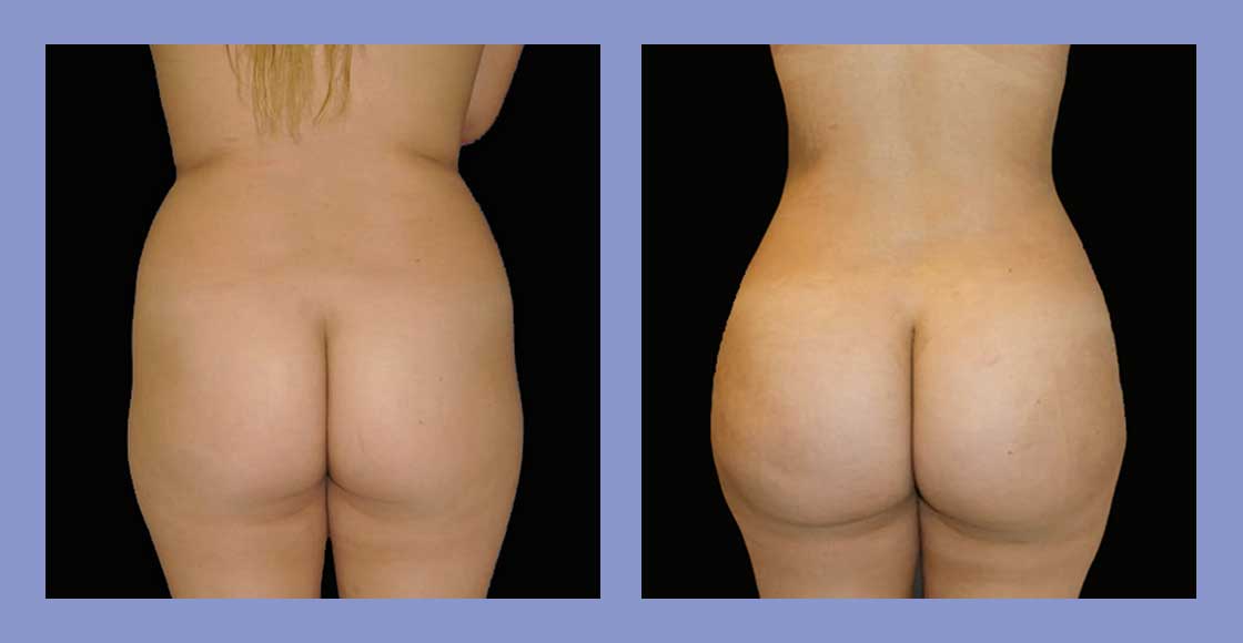 Brazilian Butt Lift - Before and After