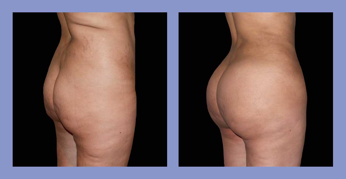 Brazilian Butt Lift - Before and After