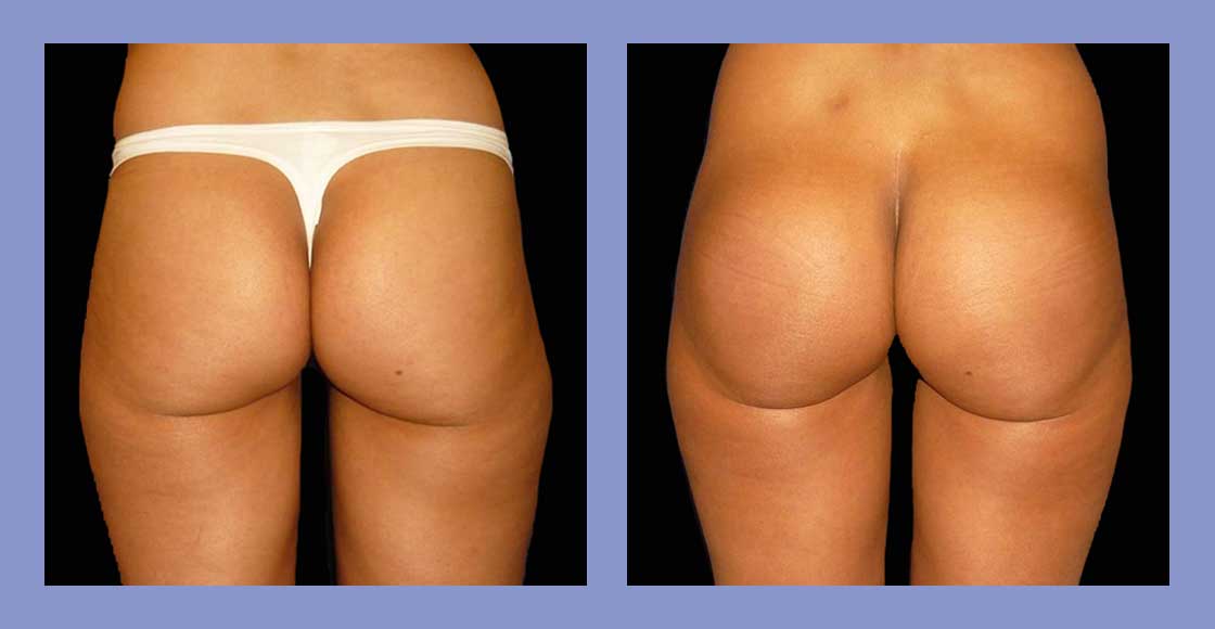 Buttock Implants Before and After