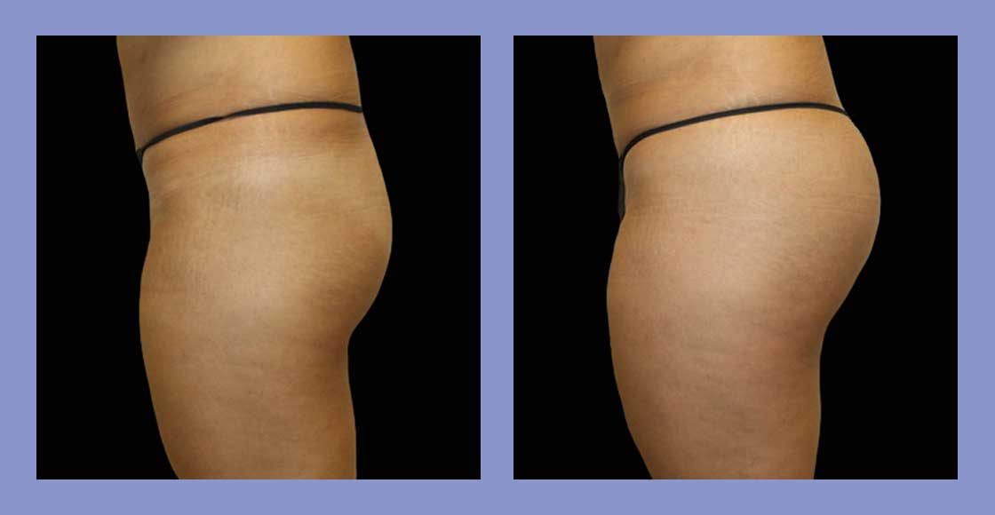 Buttock Augmentation with Implants – Verve Plastic Surgery