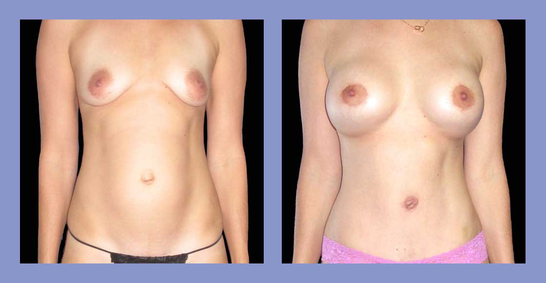 Liposuction - Before and After