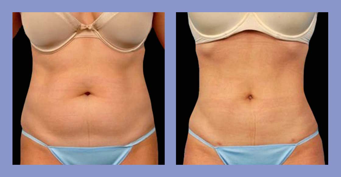 Liposuction - Before and After
