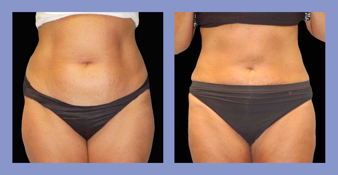 Liposuction - Before and After