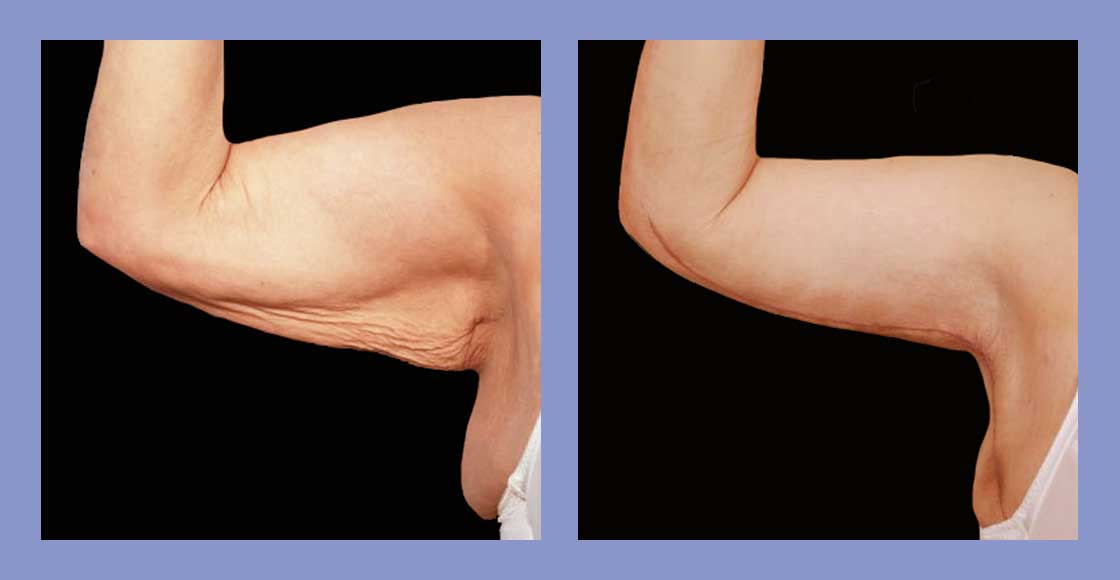 Arm Lift - Before and After