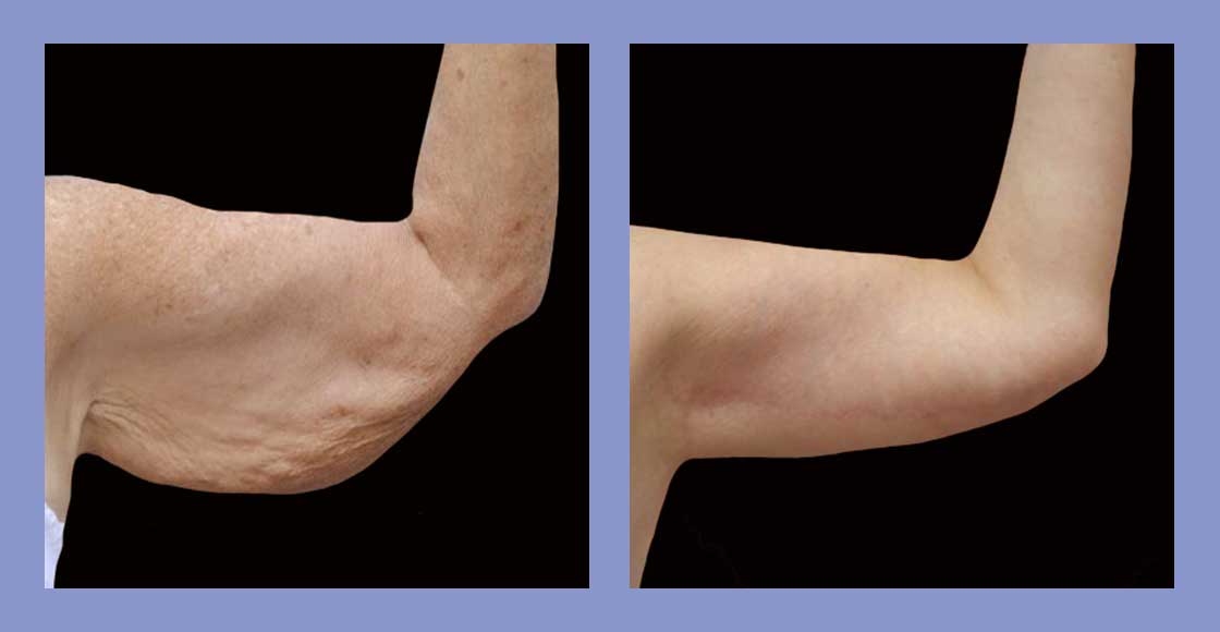 Arm Lift - Before and After