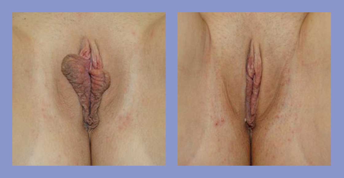 Labiaplasty - Before and After