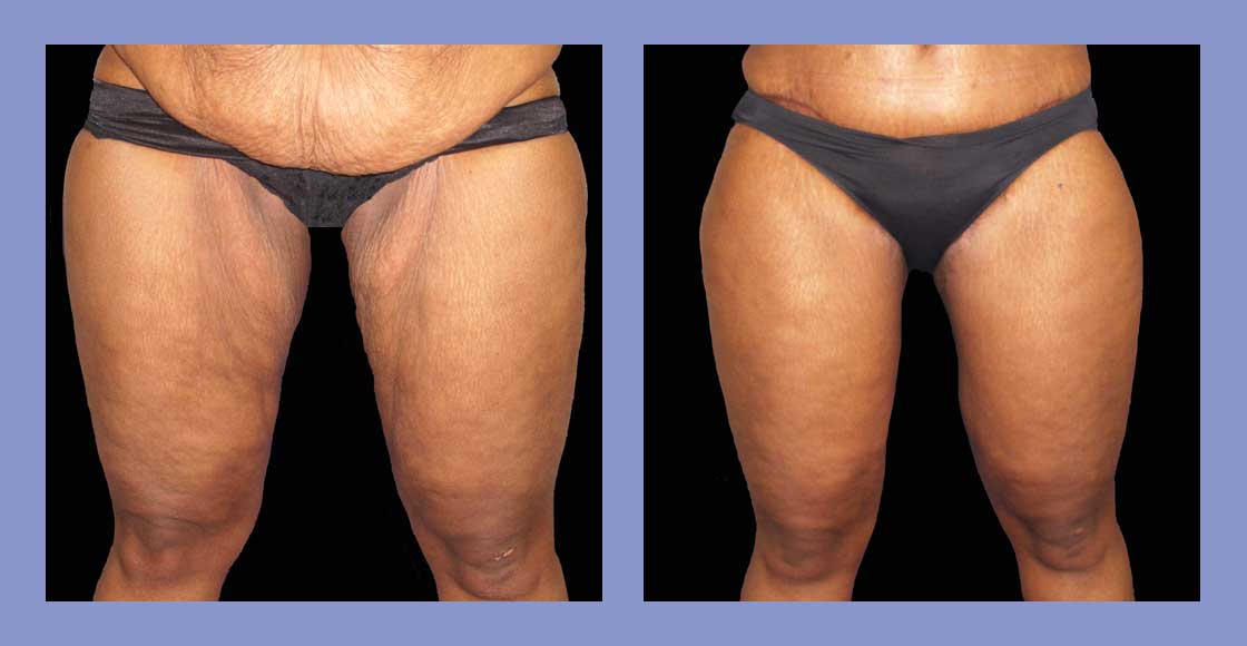 Body Thigh Lift - Before and After