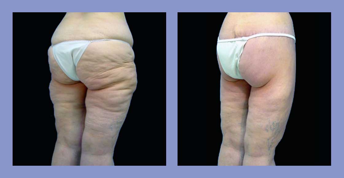 Body Thigh Lift - Before and After