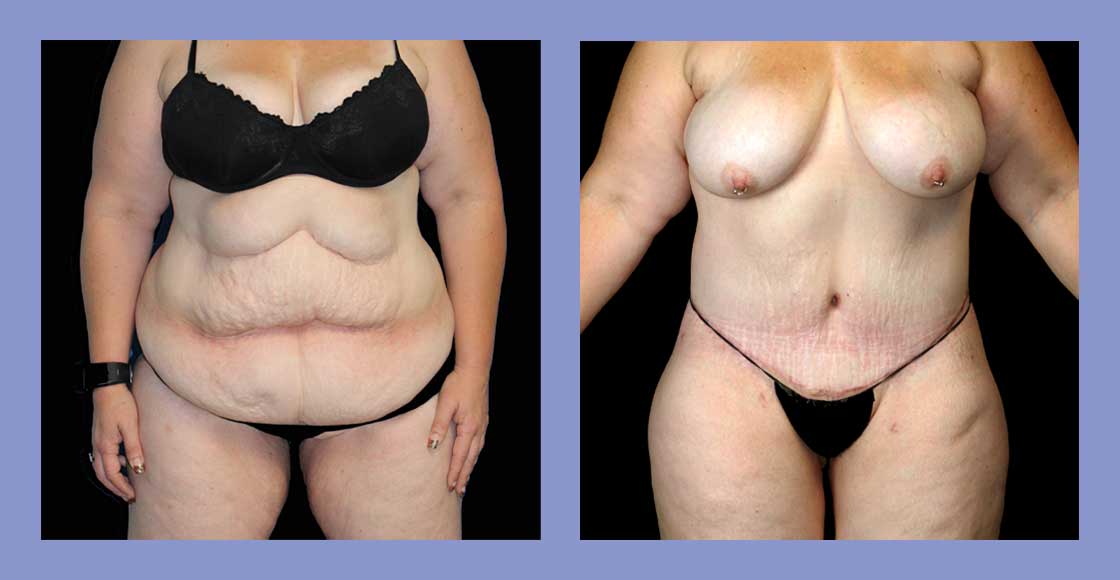 Tummy Tuck - Before and after