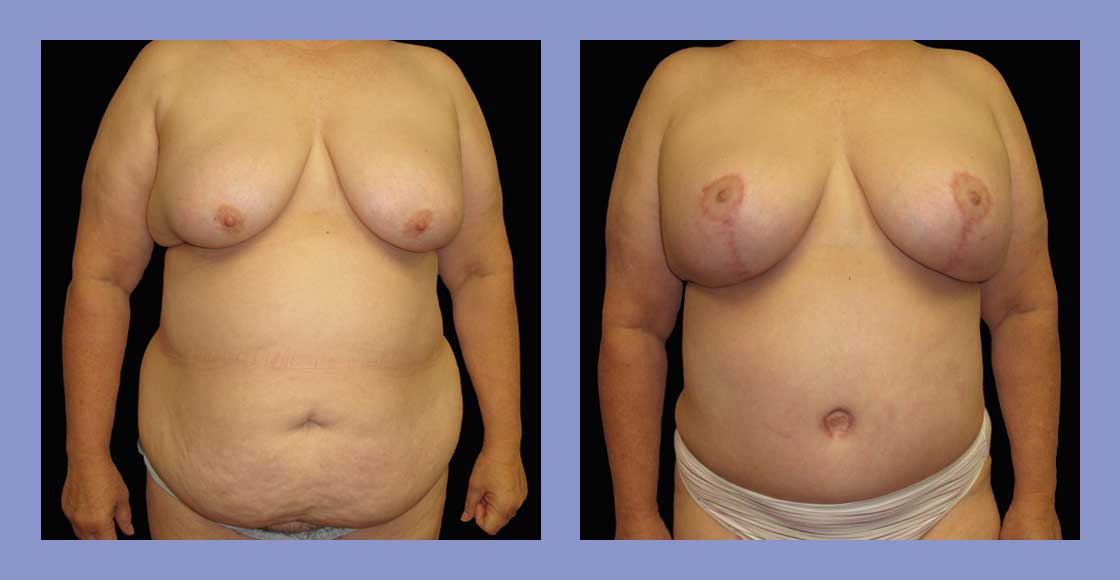 Tummy Tuck - Before and after