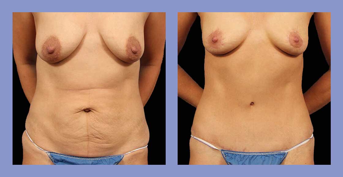 Tummy Tuck - Before and after