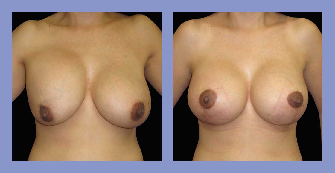 Before and after Breast Augmentation Revisions