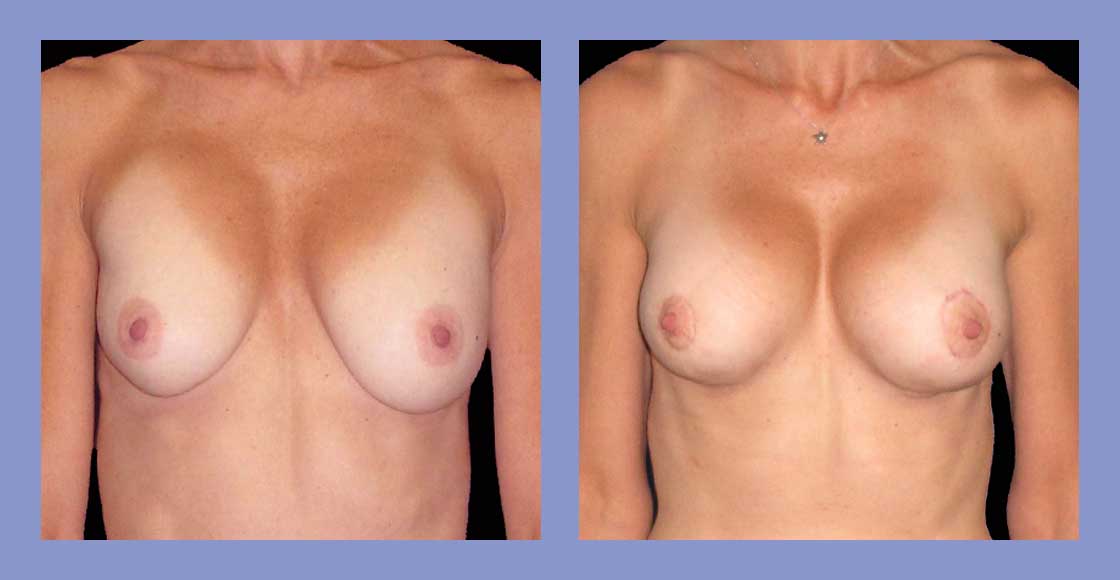 Before and after Breast Augmentation Revisions