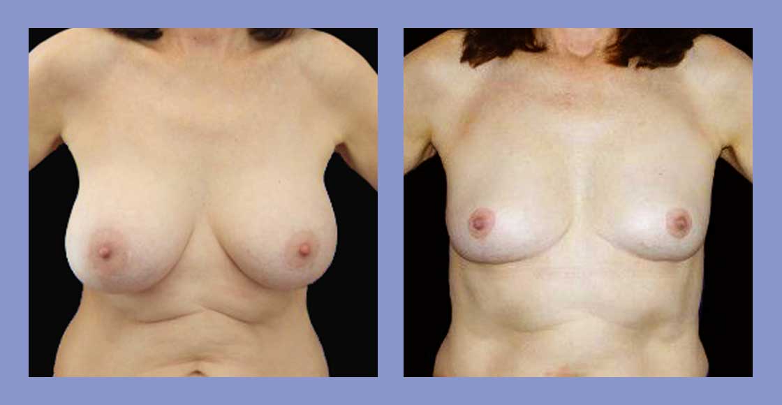 Before and after Breast Implant Removal