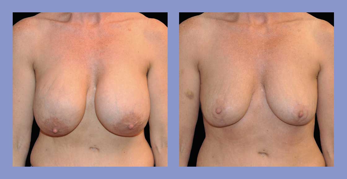 Before and after Breast Implant Removal