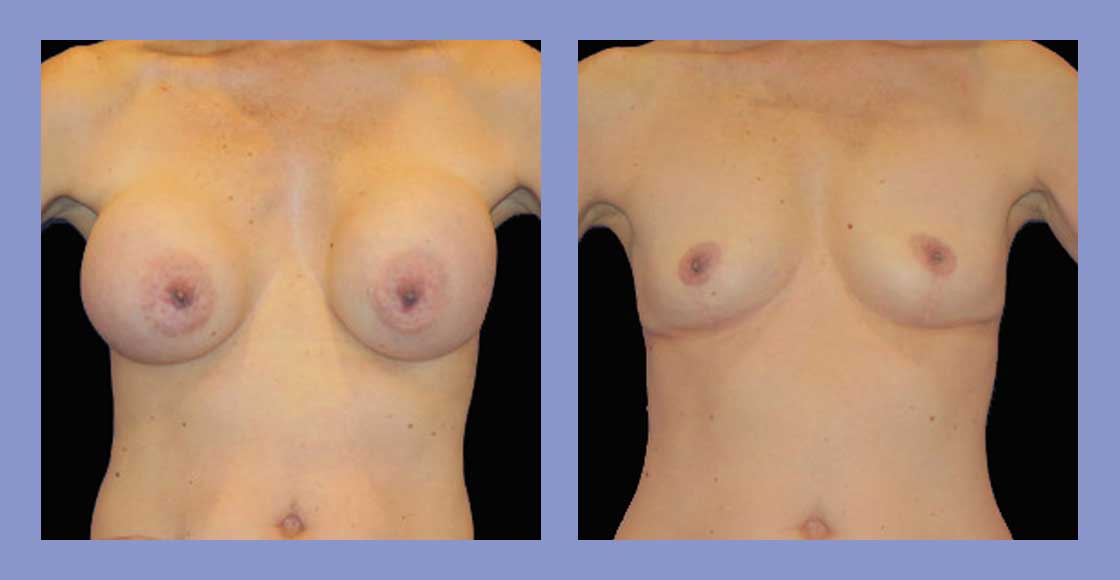 Before and after Breast Implant Removal