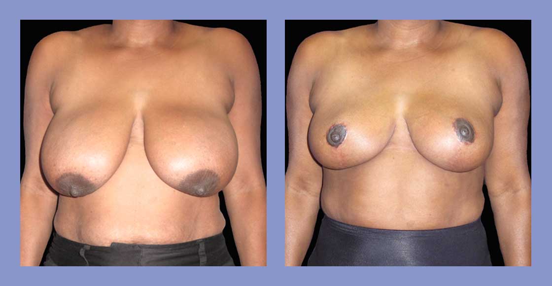 Before and after breast reduction