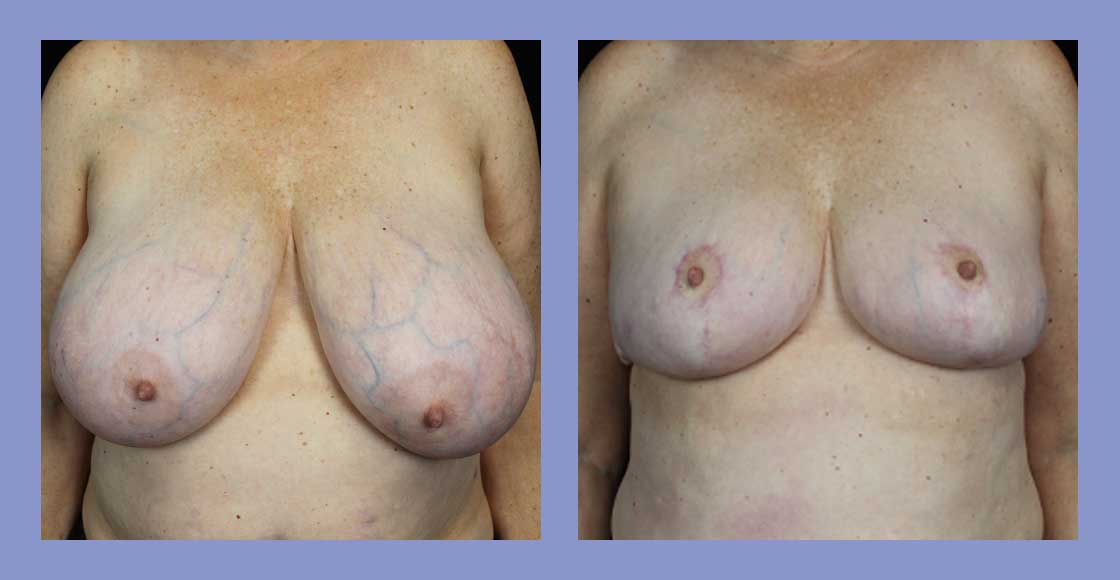 Before and after breast reduction