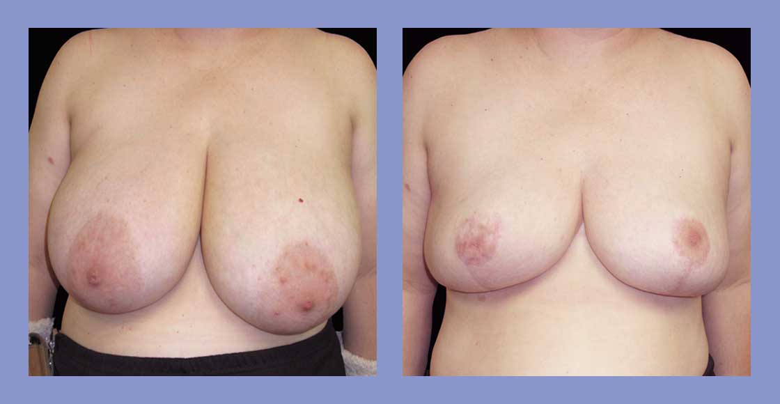 Before and after breast reduction