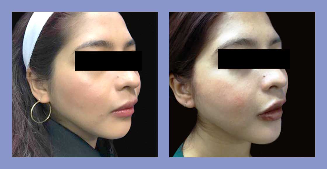 Buccal Fat Pad Removal - Before and After