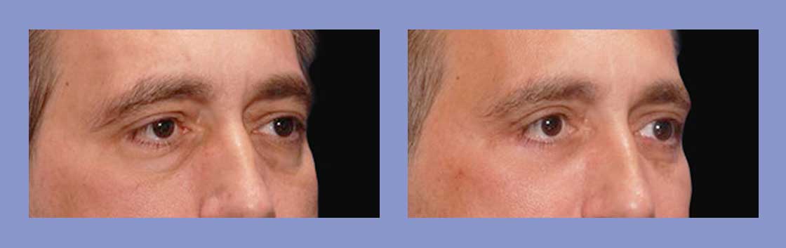 Cheek Augmentation - Before and After