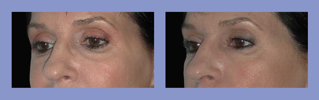 Cheek Augmentation - Before and After
