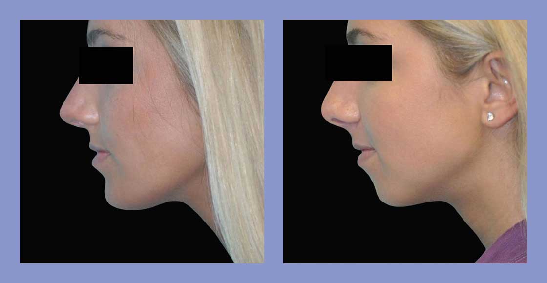 Chin Augmentation - Before and After