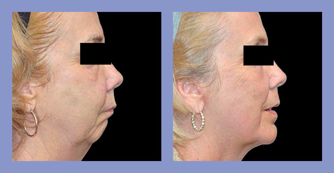 Chin Augmentation - Before and After