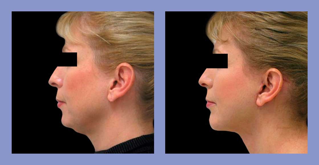 Chin Augmentation - Before and After